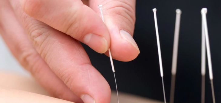 Qu’est-ce que l’acupuncture ? 6 façons d’améliorer votre santé!